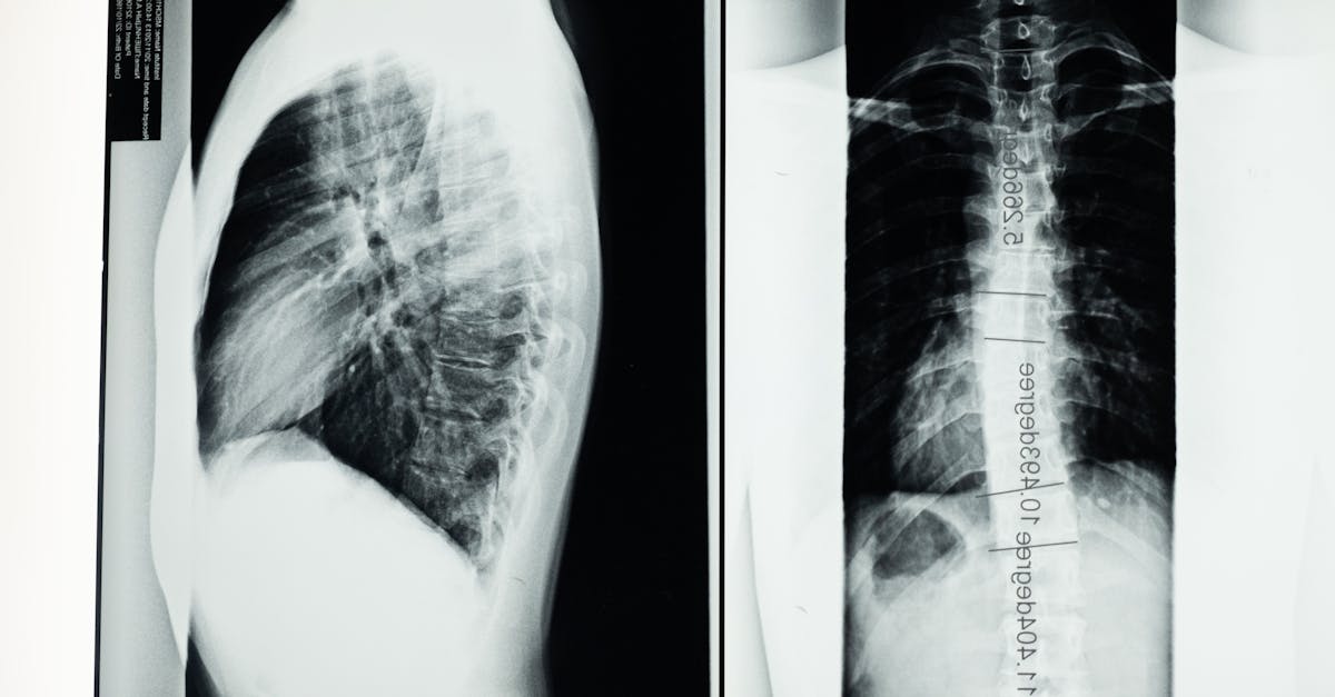 discover essential insights about scoliosis, including causes, symptoms, diagnosis, and treatment options. learn how to manage this spinal condition effectively and improve your quality of life.