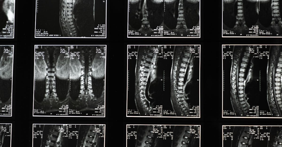 discover everything you need to know about scoliosis, including its causes, symptoms, treatment options, and how to manage this condition effectively for a healthier lifestyle.